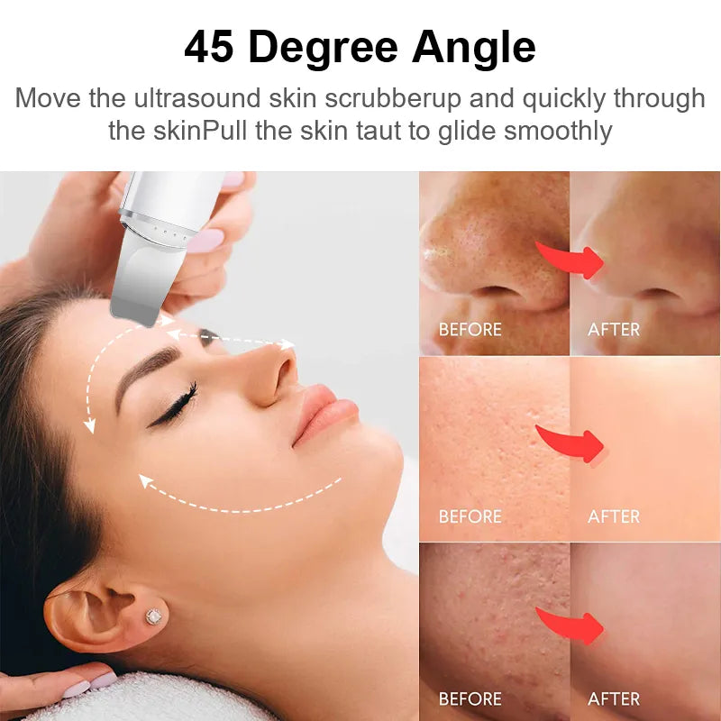 Ultrasonic Skin Scrubber Vibration Face Spatula Blackhead Remover Shovel Clean Cavitation Peeling Facial Lifting skin care